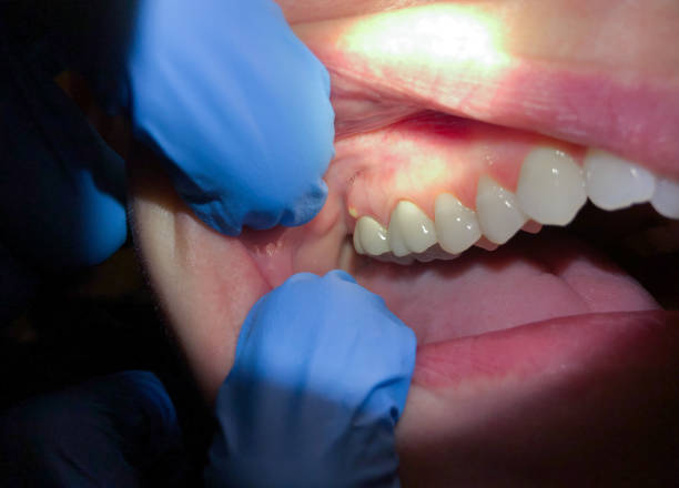 Best Emergency Gum Treatment in Wadesboro, NC
